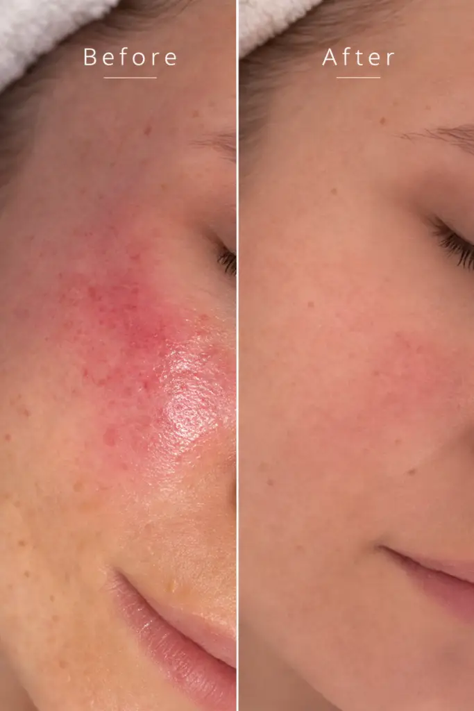 Facial treatment results for redness and inflammation showing before and after improvement