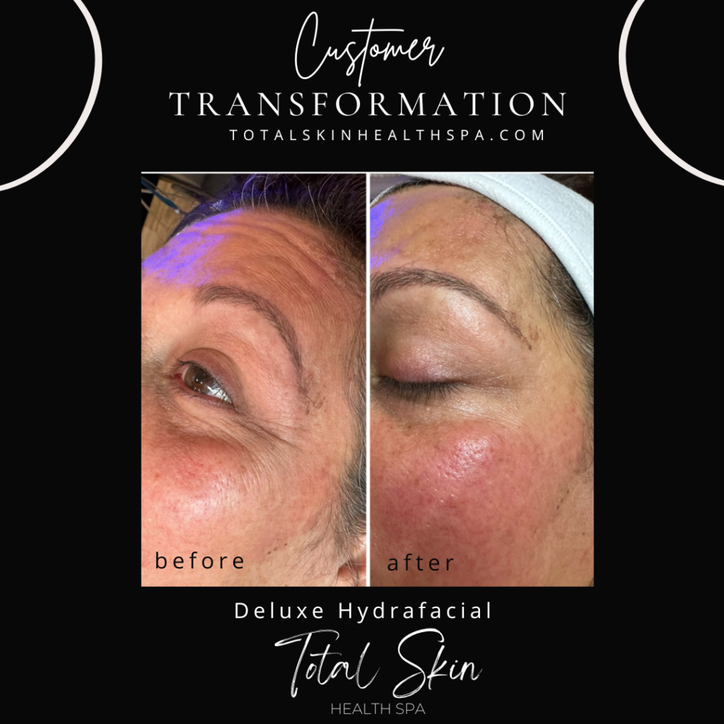 deluxe-hydrafacial-post