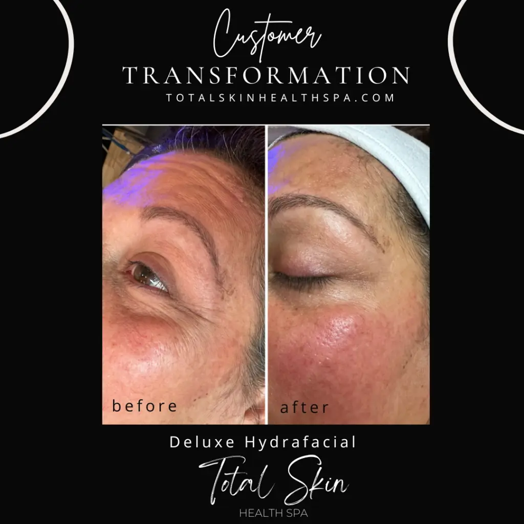 HydraFacial results showing improved skin texture and clarity before and after treatment